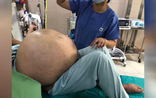 50-kg ovarian tumour, half the bodyweight of patient, removed
