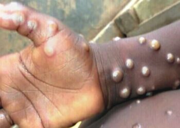 Can Mpox virus spread through air like Covid-19?