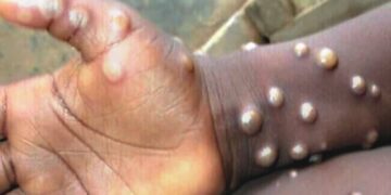 Can Mpox virus spread through air like Covid-19?